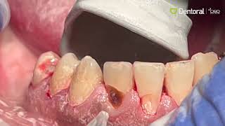 AquaCare Caries Removal [upl. by Yvi]