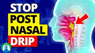 Top 10 Ways to Stop a Cough from Postnasal Drip [upl. by Attebasile]