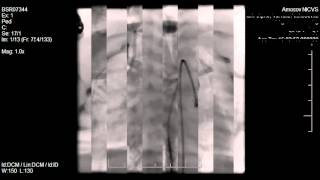 TGA Transposition of the Great Arteries Cath Lab [upl. by Nnaharas]