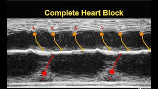 A Simplified Guide to diagnose Fetal Arrhythmia [upl. by Gwyn108]