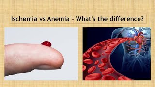 Ischemia vs Anaemia Simple way to learn [upl. by Retsevlis]