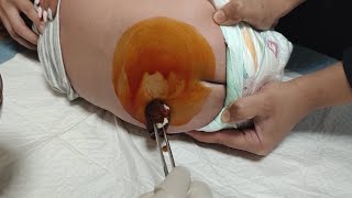 Lumbar puncture LP procedure  Spinal fluid tap [upl. by Matelda391]