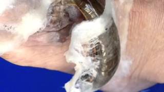 Leech Therapy in skin disease [upl. by Anawad]