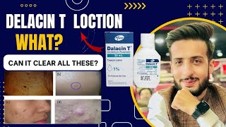 Dalacin T Lotion Clindamycin Phosphate  Get Rid of Acnes lesions  Acnes Treatment [upl. by Rosel638]