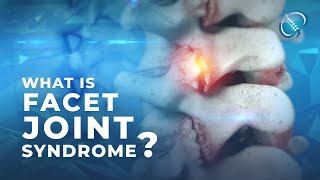 What is Facet Joint Syndrome [upl. by Analart538]