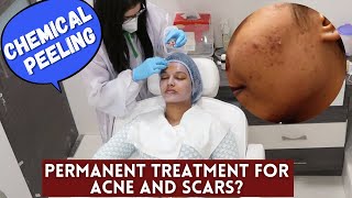 I got STRONG Chemical Peeling at the Clinic for ACNE  Is it a Permanent cureSkinTalkWSarah EP 20 [upl. by Acina]