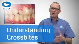 Understanding Crossbites [upl. by Warrin83]