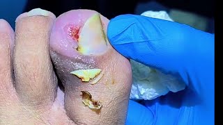 How Come This Patient Keep His Toenail So Infected Removing Huge Ingrown Toenail [upl. by Sirod]