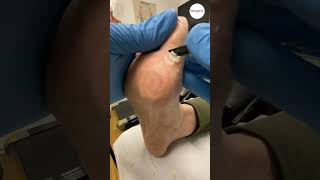 Podiatrist treats wart with acid [upl. by Draner]