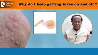 Why do I keep getting HIVES on and off  Types of Urticaria amp TriggerDrD A SatishDoctors’ Circle [upl. by Ellard679]