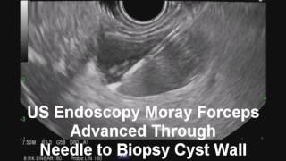 Biopsy using US Endoscopy Moray Forceps of Indeterminate Pancreas Cyst via EUSFNA [upl. by Anaeco]