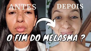 MELASMA TRATAMENTO antes e depois 4 semanas usando esse produto funcionou [upl. by Pennebaker]