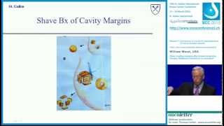 William WoodUSA Close  positive margins after breastconserving therapy [upl. by Bilat]