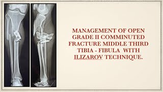 MANAGEMENT OF CRUSHED COMMINUTED FRACTURE TIBIA WITH ILIZAROV TECHNIQUE [upl. by Matthus]