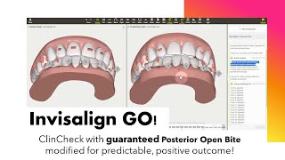 Invisalign GO ClinCheck  A modification to avoid a guaranteed Posterior Open Bite [upl. by Shakti]