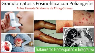 Granulomatosis Eosinofilica con poliangeitis Tratamiento homeopatico e integrativo [upl. by Adolph]