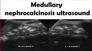 Medullary nephrocalcinosis Ultrasound [upl. by Nanfa]