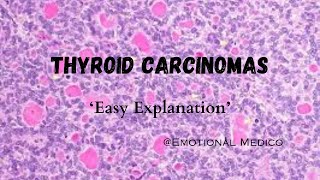 Thyroid Carcinomas  Introduction  emotionalmedico [upl. by Nilloc]