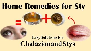 Home Remedies for Sty and Chalazion [upl. by Ilrak]