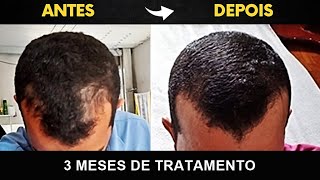 REPOSTADO CALVÍCIE MASCULINA RESULTADO DE APENAS 3 MESES [upl. by Ellecrad]