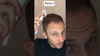 É isso que faço para crescer meu cabelo Como Aplicar Minoxidil para Calvicie Hereditaria Parte 1 [upl. by Robbie]