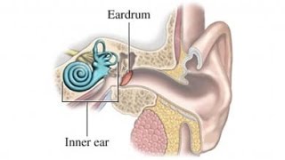 Meniere Disease [upl. by Rawlinson]