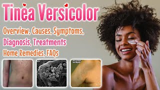 Tinea versicolor overview causes sign and symptoms diagnosis treatment home remedies and FAQs [upl. by Philina263]