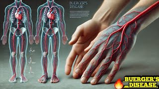 Buergers Disease Thromboangiitis Obliterans Easy Explanation [upl. by Gitt884]