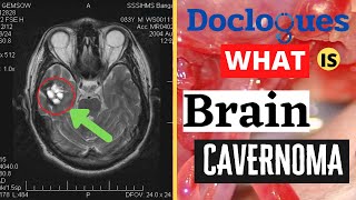 What Is Brain Cavernoma [upl. by Concettina538]