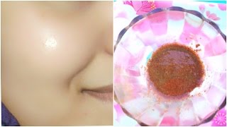 How To Remove Acne Pimples Overnight 100 Works 5 Home Remedies  Acne Scar Treatment [upl. by Delila304]