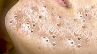 Big Cystic Acne Blackheads Extraction Blackheads amp Milia Whiteheads Removal Pimple Popping  8387 [upl. by Madai]