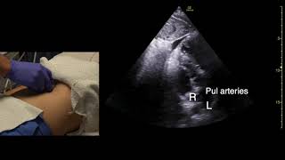 Subcostal subxiphoid Echocardiography Scan Techniques [upl. by Yrrep185]