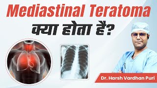 Mediastinal Teratoma क्या होता है  Mediastinal Teratoma Surgery  Dr Harsh Vardhan Puri [upl. by Heiskell]