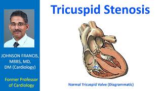 Tricuspid Stenosis [upl. by Curren]