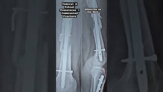 Femoral FractureTibial Fracture  Transverse Fracture Comminuted Fracture physiotherapy fracture [upl. by Groveman]