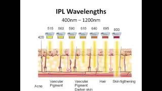 IPL vs LASER [upl. by Annoyt]