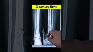 Fracture Tibia Bone xrayleg xray radiographerusn bones fracture radiography radiographer [upl. by Far617]