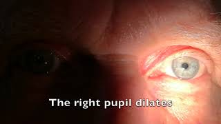 Relative afferent pupillary defect RAPD [upl. by Duj]