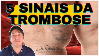 5 sinais da trombose [upl. by Ispep]