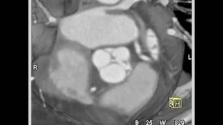 Cardiac diseased aortic valve with aortic valvular stenosis 10 of 10 [upl. by Yanffit208]