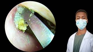 JawDropping Ear Wax Removal You Won’t Believe Your Eyesearearwax earwaxremovalearrelaxasmr [upl. by Harriott]