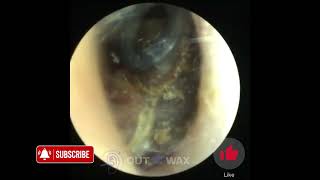 Narrow Ear Canal Makes Ear Wax Removal Harder  Out With The Wax [upl. by Lashonde177]