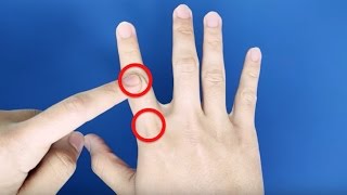 Swelling fingers  Heberdon nodes  Treatment shorts drramprasadkancherla [upl. by Znarf]