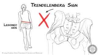 The Trendelenberg Sign HD [upl. by Einnob]