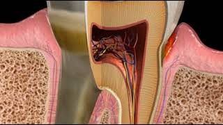 Abscess Periodontal [upl. by Lacsap]