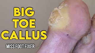 SHAVING OF REAL BIG TOE CALLUS 🦶 BIGGEST TOE CALLOUS EVER FULL TREATMENT BY MISS FOOT FIXER [upl. by Abebi]