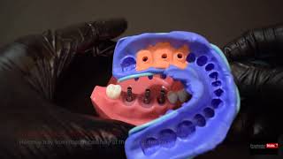 Impression Techniques for Implant Dentistry   step by step  Closed tray Impression technique [upl. by Pillihpnhoj]