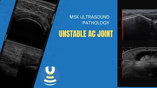 Unstable Acromioclavicular joint on ultrasound [upl. by Jabez115]