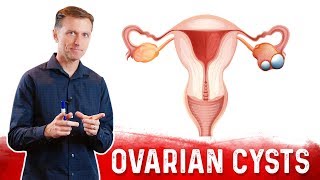 Ovarian Cysts Causes Symptoms amp Natural Treatment – DrBerg [upl. by Seerdi]