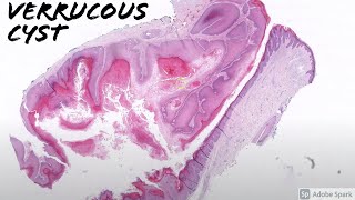 Verrucous Cyst 5Minute Pathology Pearls [upl. by Berghoff]